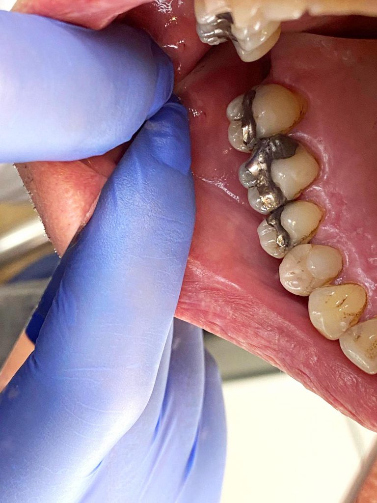 Zahnfüllungen Zahnarzt Hagen